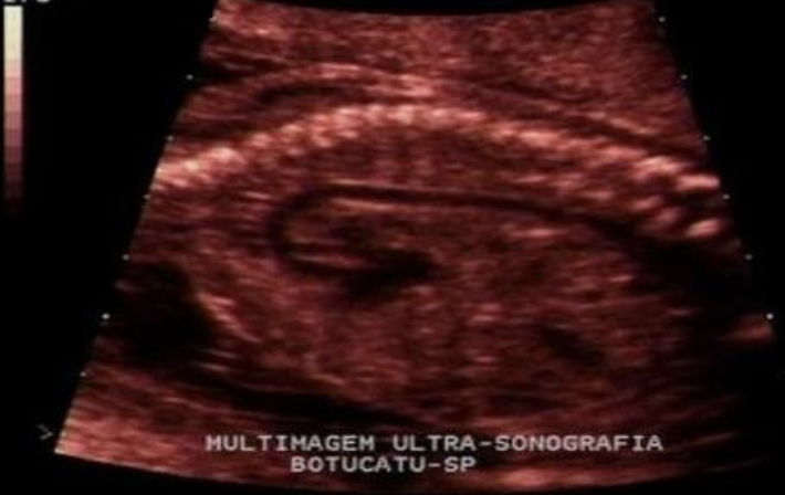 <p>the image is taken from ___ view to evaluate ___</p><p>a) sagittal, AO</p><p>b) sagittal, IVC</p><p>c) coronal, AO</p><p>d) coronal, IVC</p>