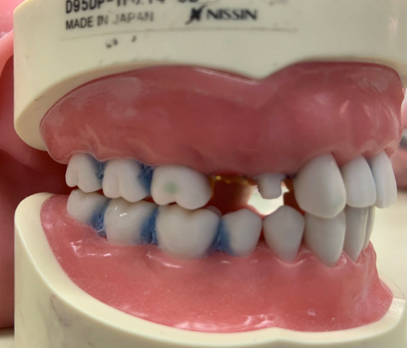 <p>What is wrong with the tooth prep on #5?</p>