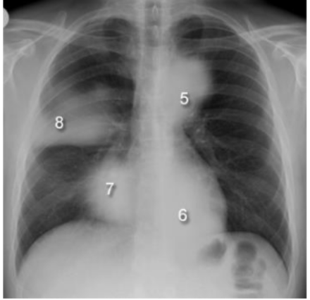 <p>What are these silhouette signs? what causes them?</p>