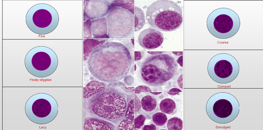 <p>Nuclear features – chromatin pattern (theory: coarser than usual suggests malignancy)</p>