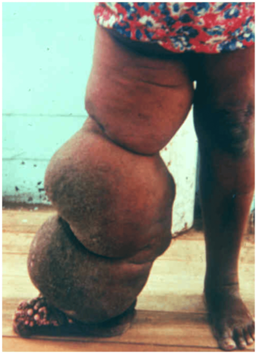 <p>• A parasite in mosquitoes that blocks the lymphatic duct<br>• Causes elephantiasis (b/c there is 1% of fluid left in interstitial fluid)<br>• Swelling occurs after many yrs.</p>