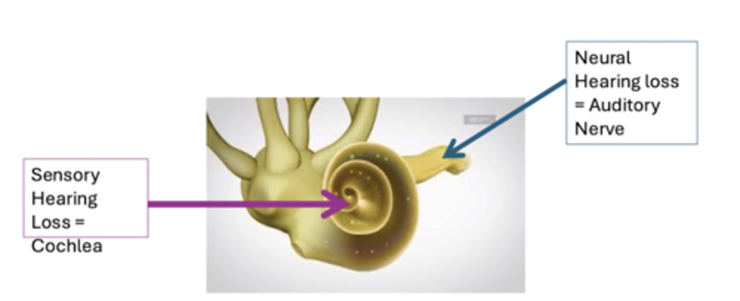 <p>Occurs when there is a problem in the inner ear; with either the cochlea (sensory hearing loss) or the auditory nerve (neural hearing loss)</p>