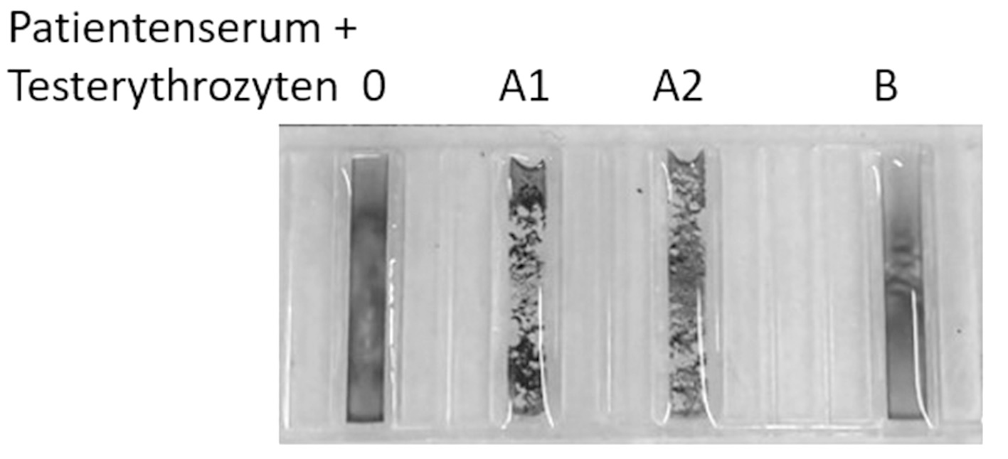 <p>6. The figure shows the result of a blood group test. Test erythrocytes of blood groups A (A₁, A₂), B, and O were each added to the patient’s serum and tested for agglutination.</p><p>Which blood group do the patient’s erythrocytes most likely have?</p><p>A. A₁</p><p>B. A₂</p><p>C. A₁ and A₂</p><p>D. B</p><p>E. AB</p>