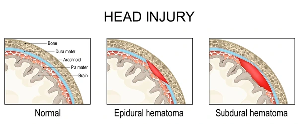 <p>They are brain injuries affecting layers of the meninges. They’re caused by too much pressure in the skull, head injuries, or vessel rupture</p><ul><li><p>Epidural hematoma: blood between skull and dura mater</p></li><li><p>Subdural hematoma: blood between arachnoid and dura mater</p></li></ul><p></p>