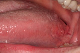 <p>foliate papillae</p>