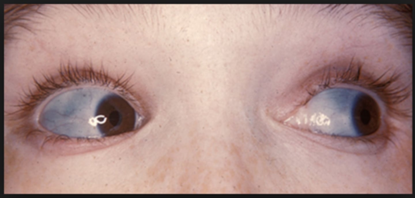 <p>Dentinogenesis imperfecta - dentin dysplasia that causes teeth to be discolored and translucent giving teeth an opalescent sheen</p>