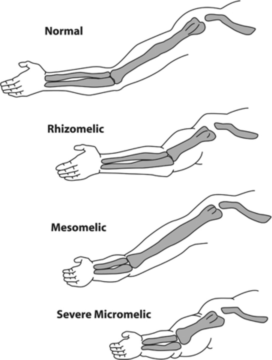 <p>Shortening of proximal long bones such as the femur and humerus.</p>