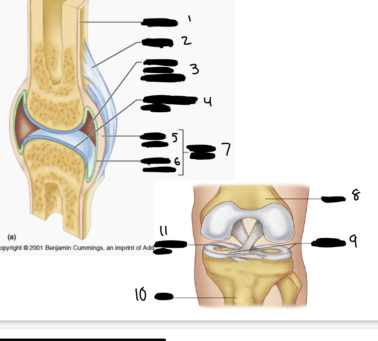 <ol><li><p>periosteum</p></li><li><p>ligament</p></li><li><p>joint cavity (contains synovial fluid)</p></li><li><p>articular cartilage (hyaline)</p></li><li><p>fibrous capsule</p></li><li><p>synovial membrane</p></li><li><p>articular capsule</p></li><li><p>femur</p></li><li><p>meniscus</p></li><li><p>tibia</p></li><li><p>meniscal tear</p></li></ol>