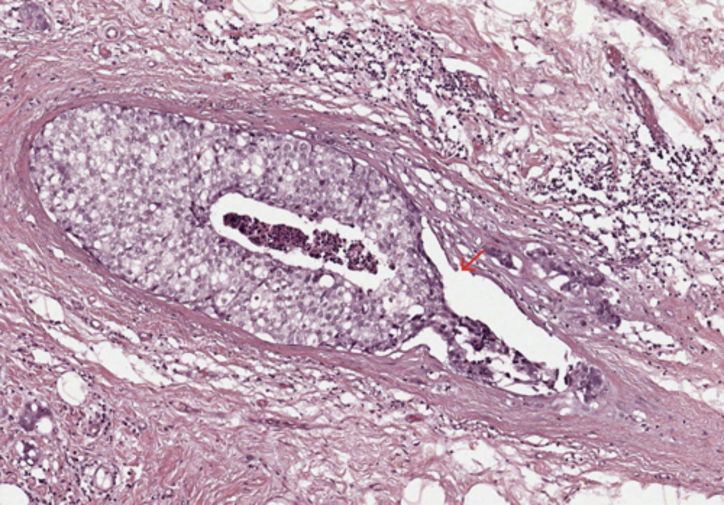 <p>Breast</p>