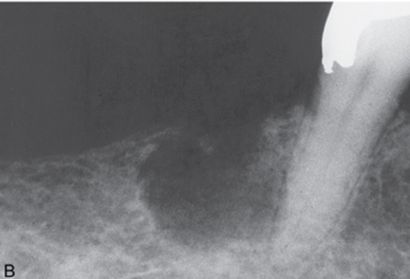 <p>-composed of odontogenic epithelium that contains "ghost cells"</p><p>-also referred to as gorlin cyst</p><p>-most commonly seen individuals younger than 40 years</p><p>-lesions occur equally in the maxilla and mandible, most often in the incisor and cuspid area</p><p>-present as well defined unilocular or multilocular radiolucency</p>