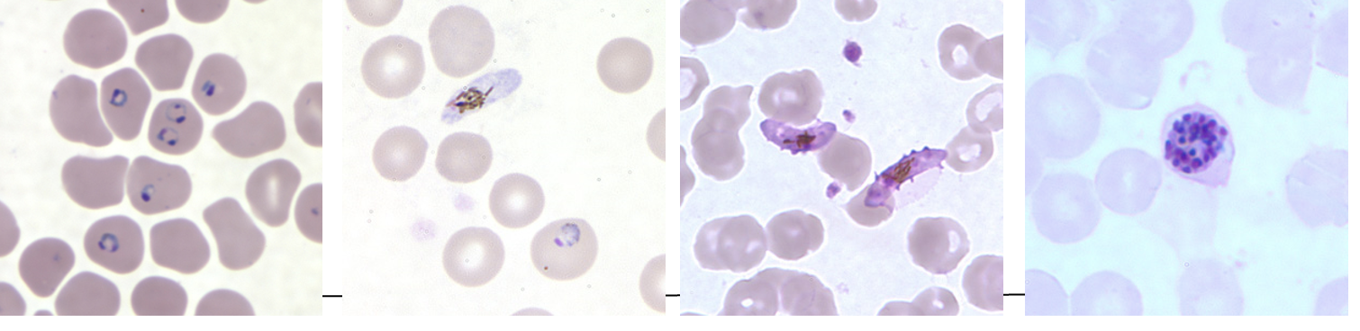 <p><strong>Thick and thin blood smears</strong> (look for <strong>trophozoite "signet rings"</strong>)</p>