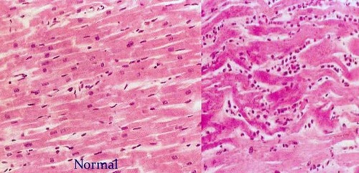 <p>Coagulative necrosis of the heart</p>