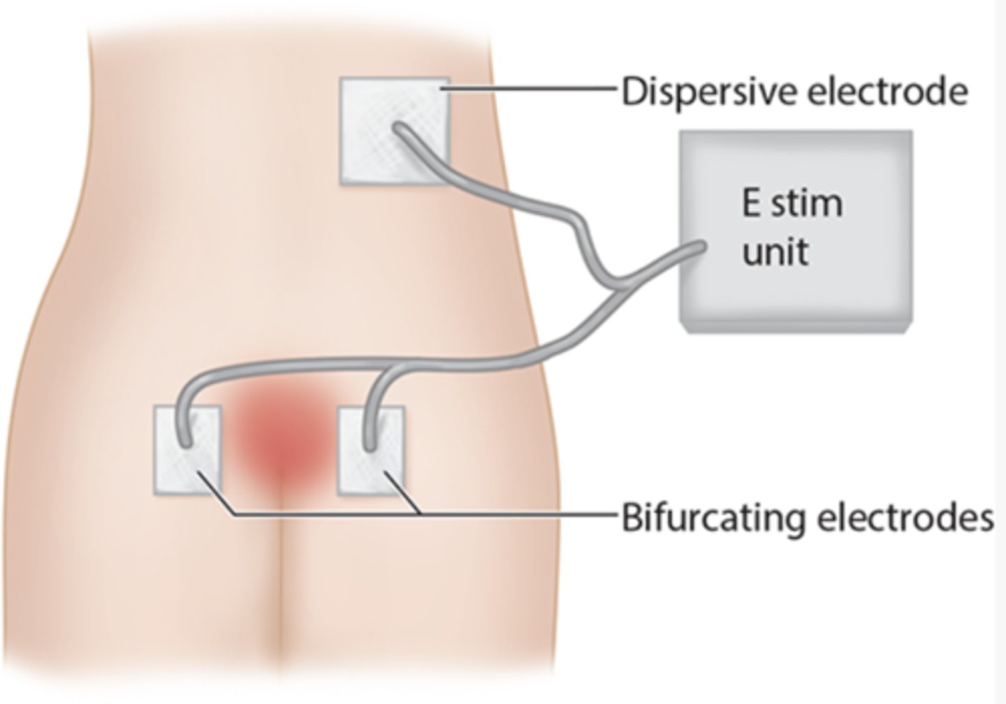 <p>fill negative cavity with hydrogel sheet/moistened gauze and secure in place then place electrodes straddling the wound bed 2-15 cm from wound edge</p><p>*rotate position of electrodes each treatment</p><p>**place larger dispersive pad 20-30 cm from wound</p><p>TREATMENT PARAMETERS:</p><p>- HVPC, 60 mins, 5-7 days/week</p>