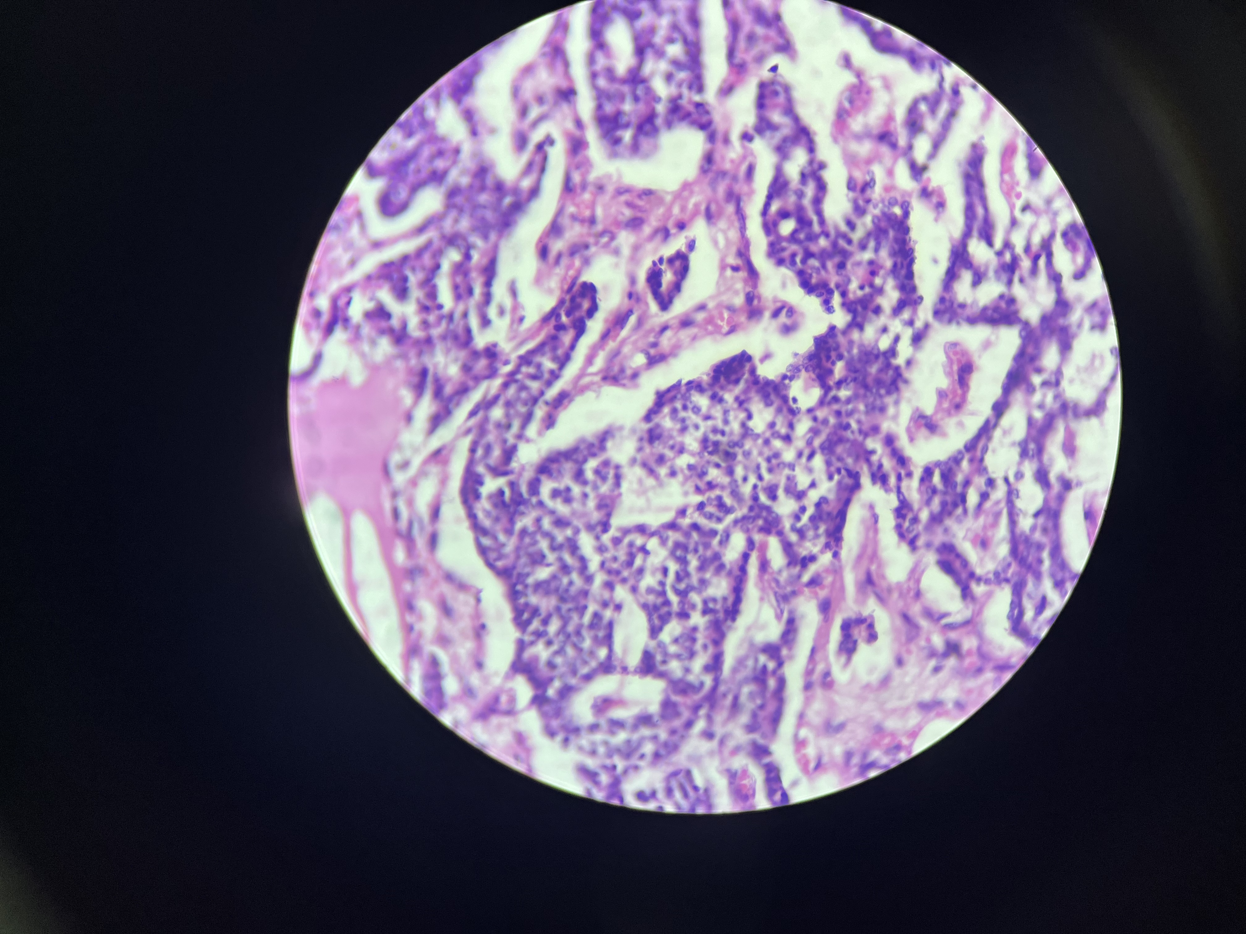 <p>Histomorphologic finding: Oxyphil cells, Proliferating chief cells.</p>
