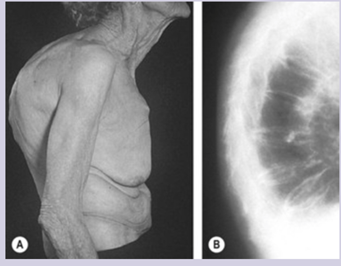 <p>-asymptomatic until fracture </p><p>-fragility fracture = fracture from fall from standing height </p><p>-loss of height </p><p>-kyphosis</p><p>-decreased rib to pelvis ratio </p>