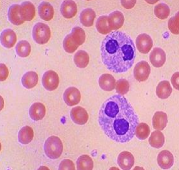 <p>neutrophil has 2 segments or LESS</p><ul><li><p>congenital or acquired (ex. CML).</p></li></ul><p></p>