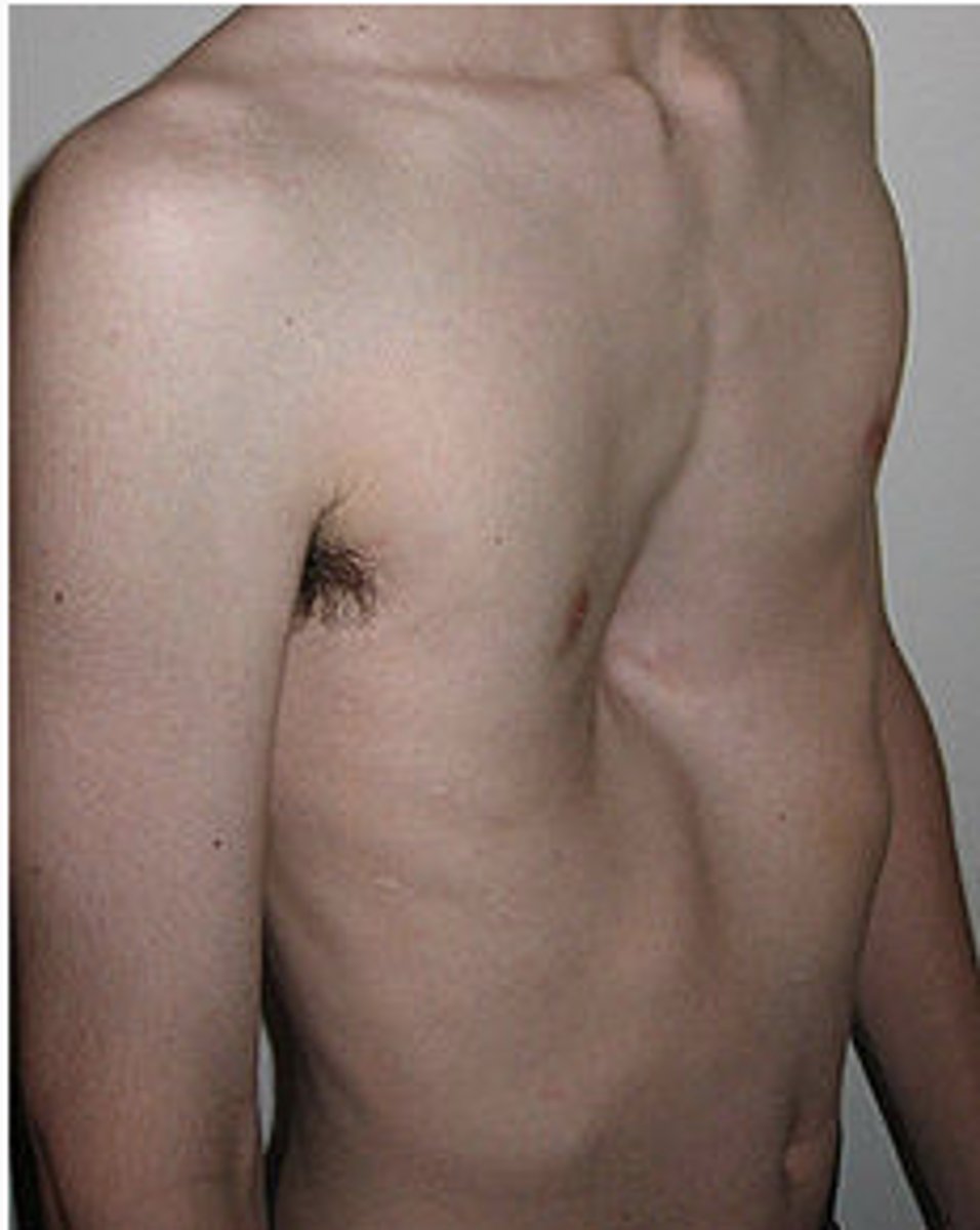 <p>-depression of the chest wall</p><p>-symmetrical or asymmetrical</p><p>-associated with: congenital heart disease, PCD, neuromuscular disorder </p>