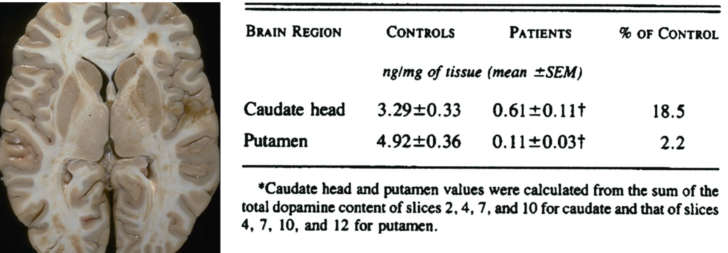 <p>in parkinson’s disease, postmortem analysis indicates that dopamine loss is greatest in the putamen</p>