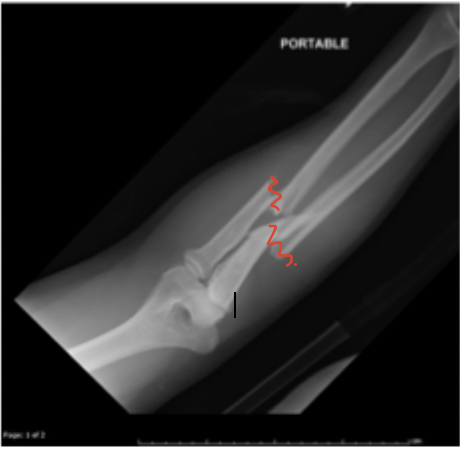 <p>Initial eval of Both bone forearm fracture includes</p>