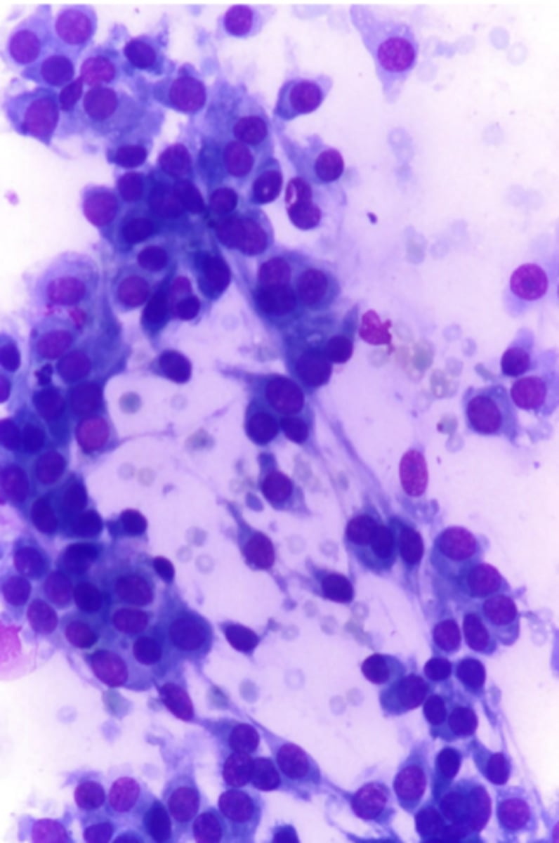 <p>What type of neoplastic tumor is this?</p><p>- Very exfoliative, sheets of cells that break away into a single spindle cells</p>