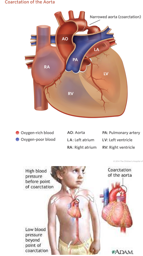 <p><strong><u>Obstructive</u> Disorder</strong></p><ul><li><p class="">Narrowing of the aortic lumen.</p></li><li><p class=""><strong>BP in all 4 extremities</strong>:</p><ul><li><p class=""><em><u>Upper extremities</u></em> will be <em><u>higher than lower</u></em>.</p></li></ul></li><li><p class="">Heart Failure Symptoms</p></li><li><p class=""><strong>Care:</strong></p><ul><li><p class=""><em><u>Cluster care</u></em> to minimize stress.</p></li><li><p class=""><em><u>Digoxin</u></em> administration to help increase cardiac output and perfusion.</p></li><li><p class=""><em><u>Diuretics</u></em> to reduce edema.</p></li><li><p class="">Higher calorie feeds.</p></li></ul></li></ul><p></p>