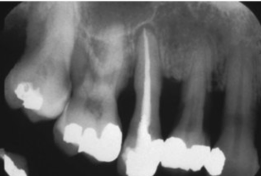 <p>Cementum Conservation when Instrumenting:</p>