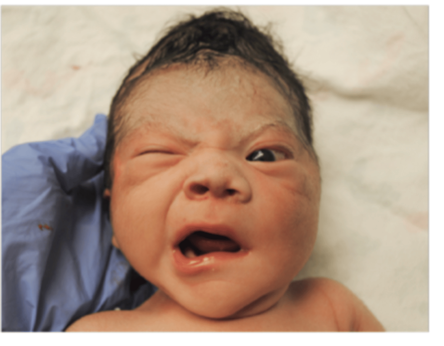 <p>Facial Nerve Palsy</p><p>Peripheral (lower motor neuron) paralysis of the facial nerve may be from (1) an injury to the nerve from pressure during labor and birth, (2) inflammation of the middle ear branch of the nerve during episodes of acute or chronic otitis media, or (3) unknown causes (Bell palsy).</p>