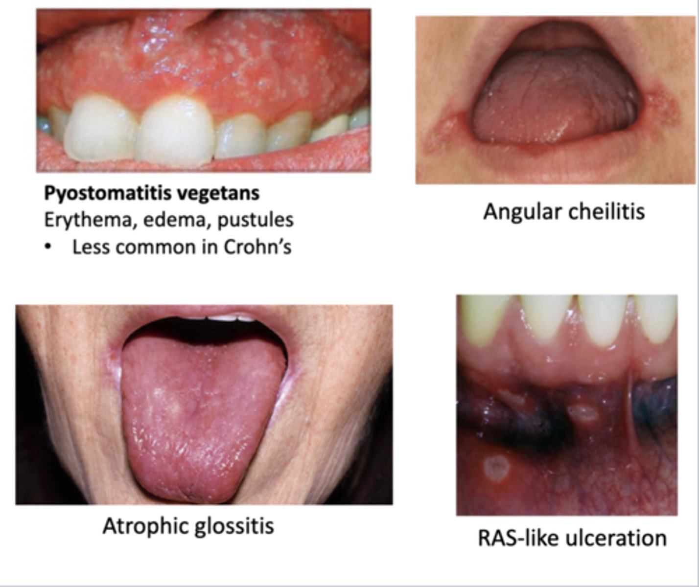 <p>-pyostomatitis vegetans --&gt; erythema, edema, &amp; pustules of gingiva (low occurrence but more likely here than in crohn's)</p><p>-RAS-like ulceration</p><p>-angular cheilitis</p><p>-atrophic glossitis</p><p>-other anemia findings</p>