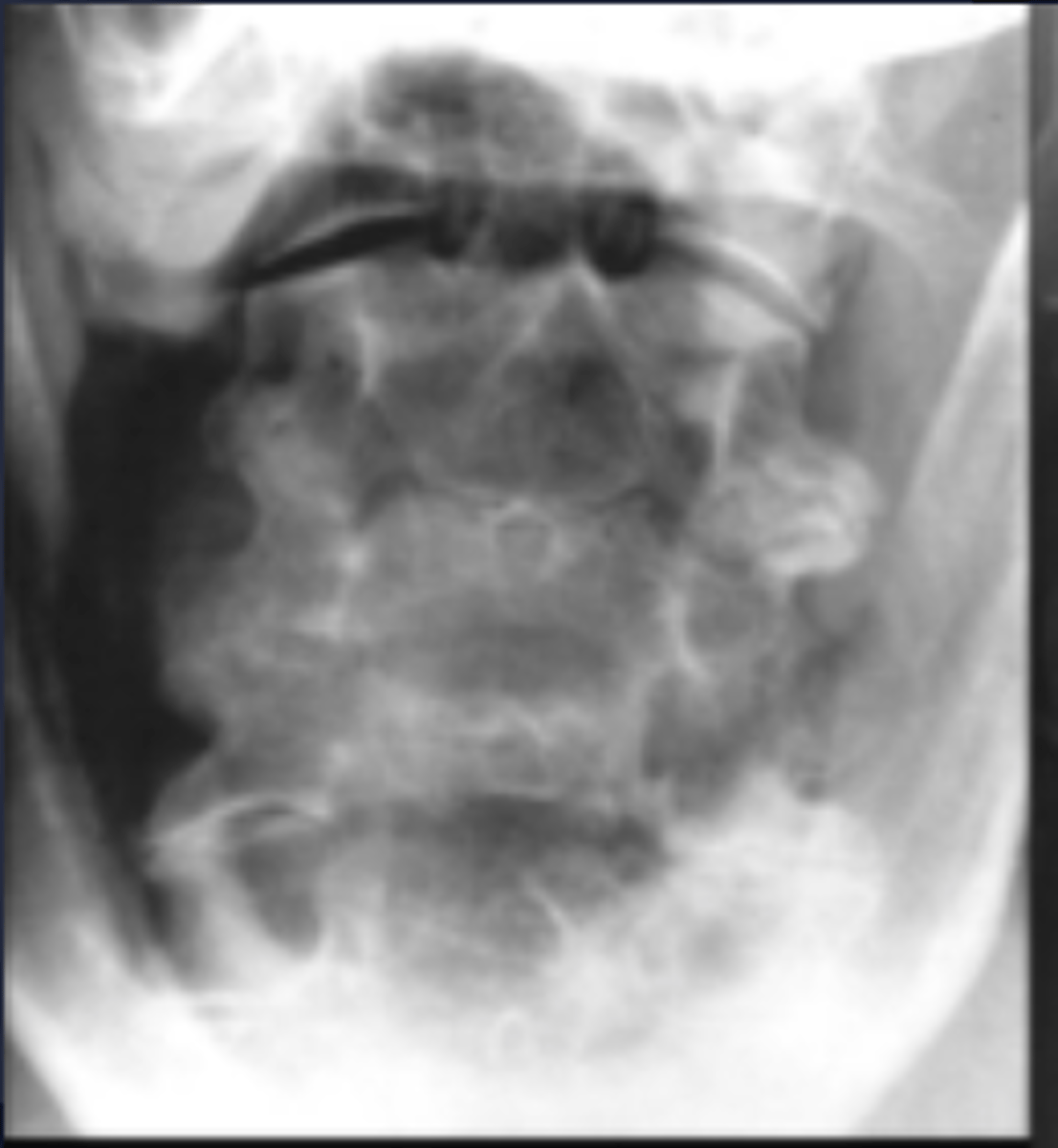 <p>- Enlargement of facet joints</p><p>- May be the result of the body responding to degenerative disease</p>