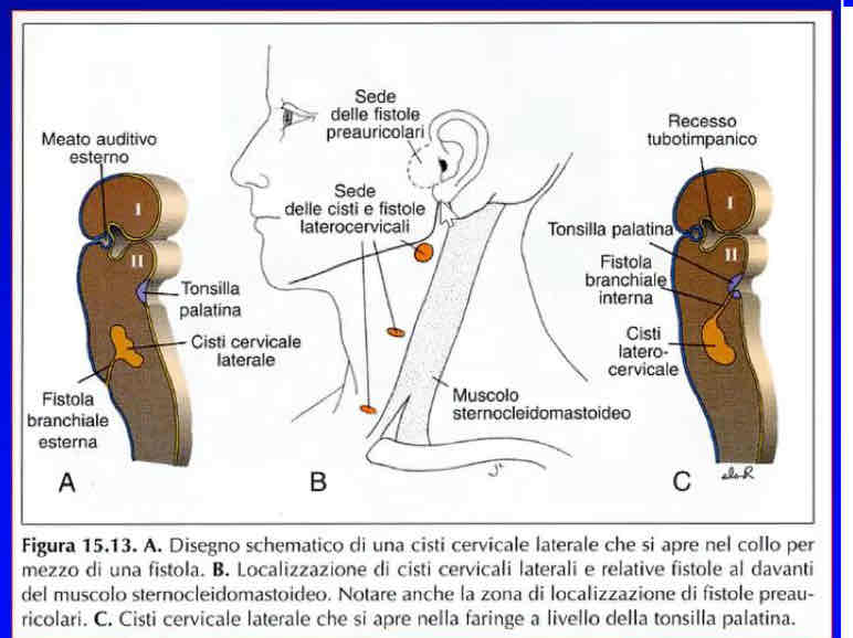 <p>Si trasformano in strutture cistiche che possono essere confuse per linfonodi con cellule tumorali.</p>