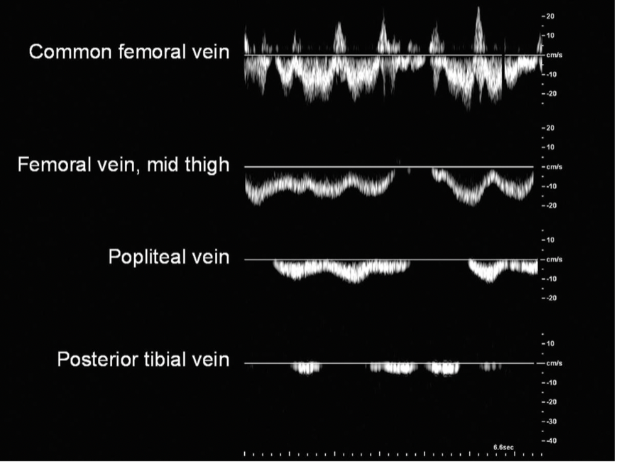 <p>Based on these waveforms, explain at what point the patient is breathing in vs out </p>