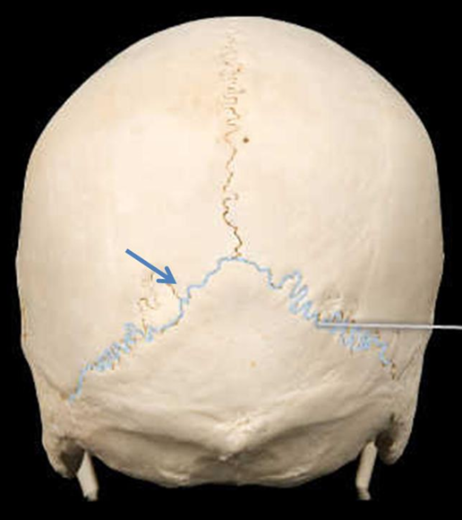 <p>lambdoid, parietal, bregma, or sagittal</p>