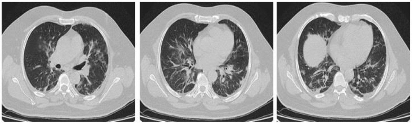 <ul><li><p>is an air-space disease and may be indistinguishable from pneumonia of other causes</p></li><li><p><strong>Ground glass opacity</strong> sign</p><ul><li><p>This refers to the hazy gray areas that show up in CT scans of the lungs</p></li></ul></li></ul><p></p>