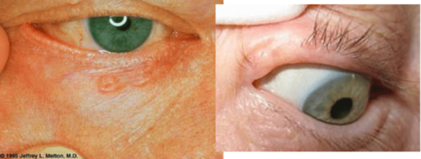<p>same as nodular/superficial spreading but with more pigment = more common in more pigmented pt</p>