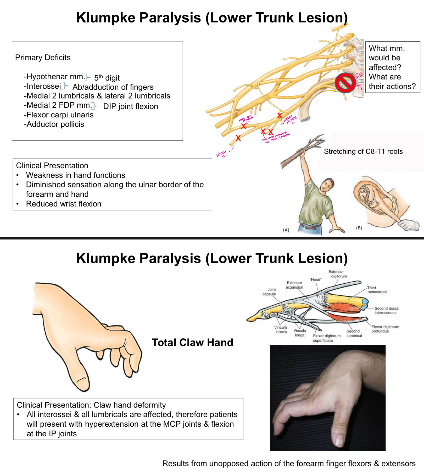 <p>Hypothenar mm. - 5th digit</p><p>Interossei - ab/adduction of fingers</p><p>Medial 2 lumbricals and lateral 2 lumbricals</p><p>Medial 2 FDP mm. - DIP joint flexion</p><p>Flexor carpi ulnaris</p><p>Adductor pollicis</p>