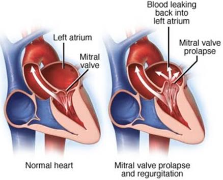<p>Mitral valve prolapse (MVP)</p>