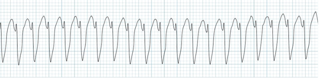 <p><u>VENTRICULAR TACHYCARDIA - with pulse nursing action</u></p>