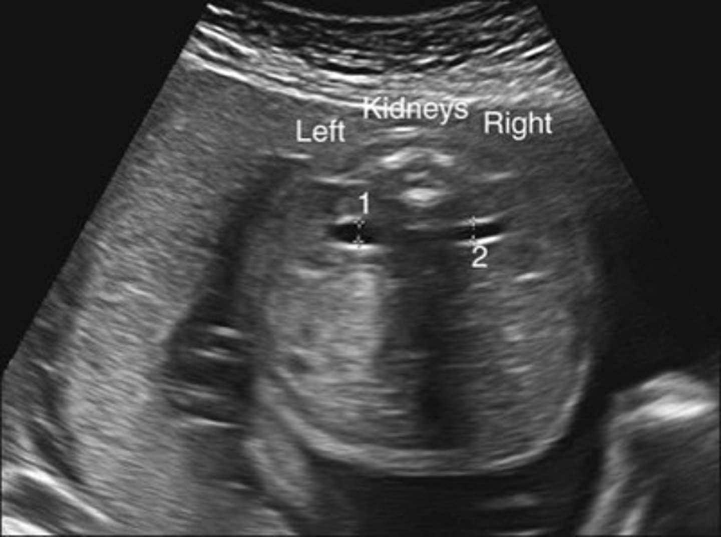 <p>Fluid within renal pelvis, but small enough to be considered insignificant/within normal range</p>