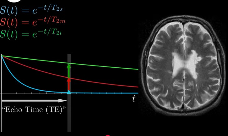 <p>how long you wait to detect signal once spins have been knocked out of alignment with field/excited</p><p>parameter chosen by MRI technician deliberately to maximise contrast between tissues of interest</p><p>at certain echo time, tissue has different signal strength, corresponding to different brightness of tissue</p>