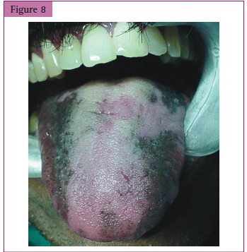 <p>Diffuse pigmentation of tongue in __________ patient.</p>