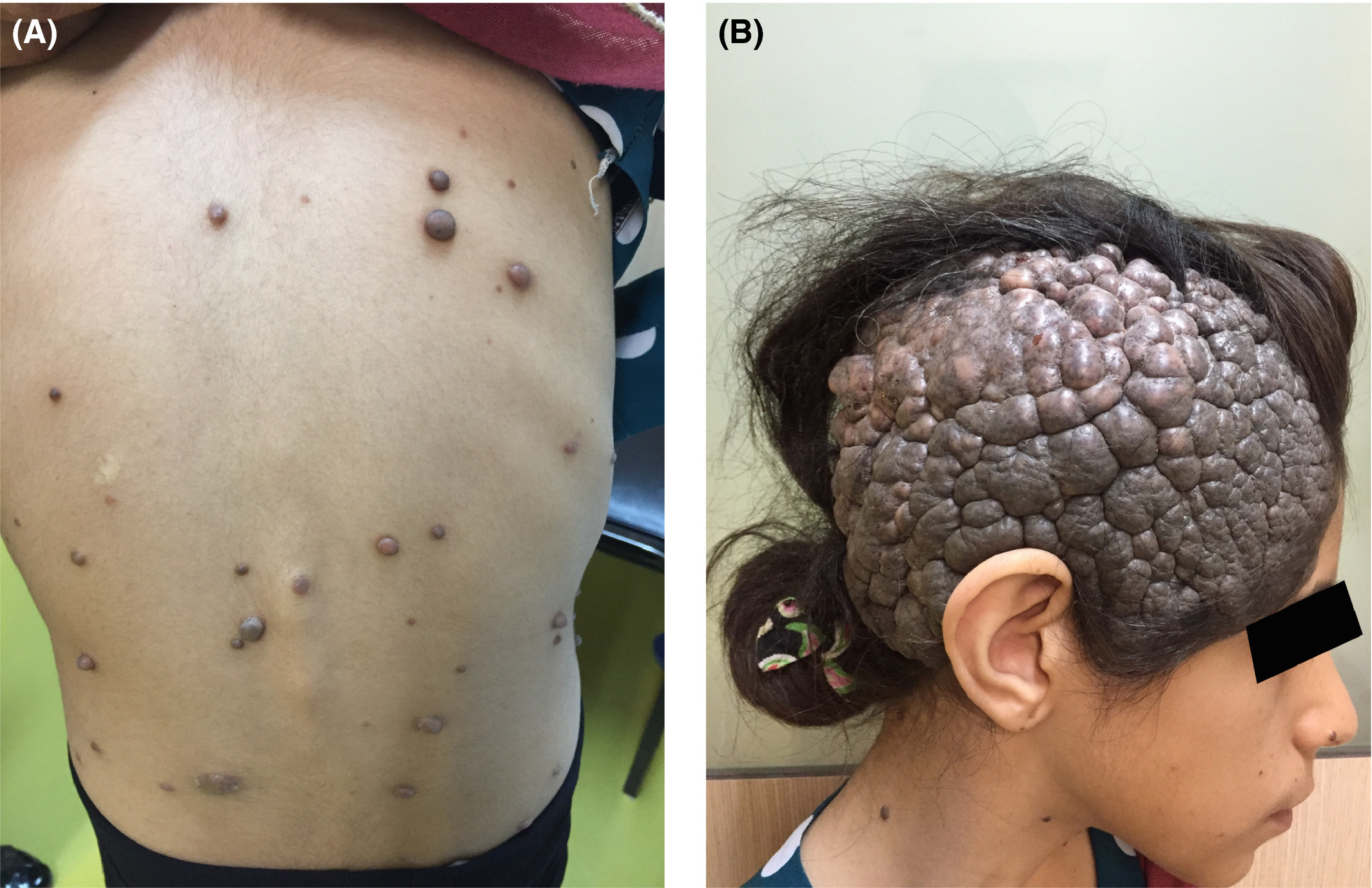 <p>Nevus (pl. nevi)</p>