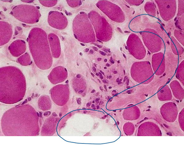<p>most commonly occurring dystrophy with an <strong><span style="color: red">X-linked defect </span>causing <span style="color: red">deficiency</span> in <span style="color: red">dystrophin</span></strong></p><p>morphology</p><ul><li><p>ongoing damage in the form of <strong><mark data-color="blue">segmental myofiber degeneration &amp; regeneration associated with an admixture of atrophic myofibers</mark></strong></p></li><li><p>muscle tissue is <strong><mark data-color="blue">replaced by collagen &amp; fat cells (“fatty replacement” or “fatty infiltration“) leading to pseudohypertrophy of the calves</mark></strong></p></li></ul><p>clinical presentations</p><ul><li><p>first indications of <strong><mark data-color="green">muscle weakness are clumsiness &amp; inability to keep with with peers around age 5</mark></strong></p></li><li><p>weakness <strong><mark data-color="green">begins in the pelvic girdle muscles &amp; then extends to the shoulder girdle (proximal muscles)</mark></strong></p></li><li><p>mean age of <strong><mark data-color="green">wheelchair dependence is around 9.5 years</mark></strong></p></li><li><p><strong><mark data-color="green">mean age of death is 25 - 30 years of age (from respiratory insufficiency, pulmonary infection, or heart failure)</mark></strong></p></li></ul>