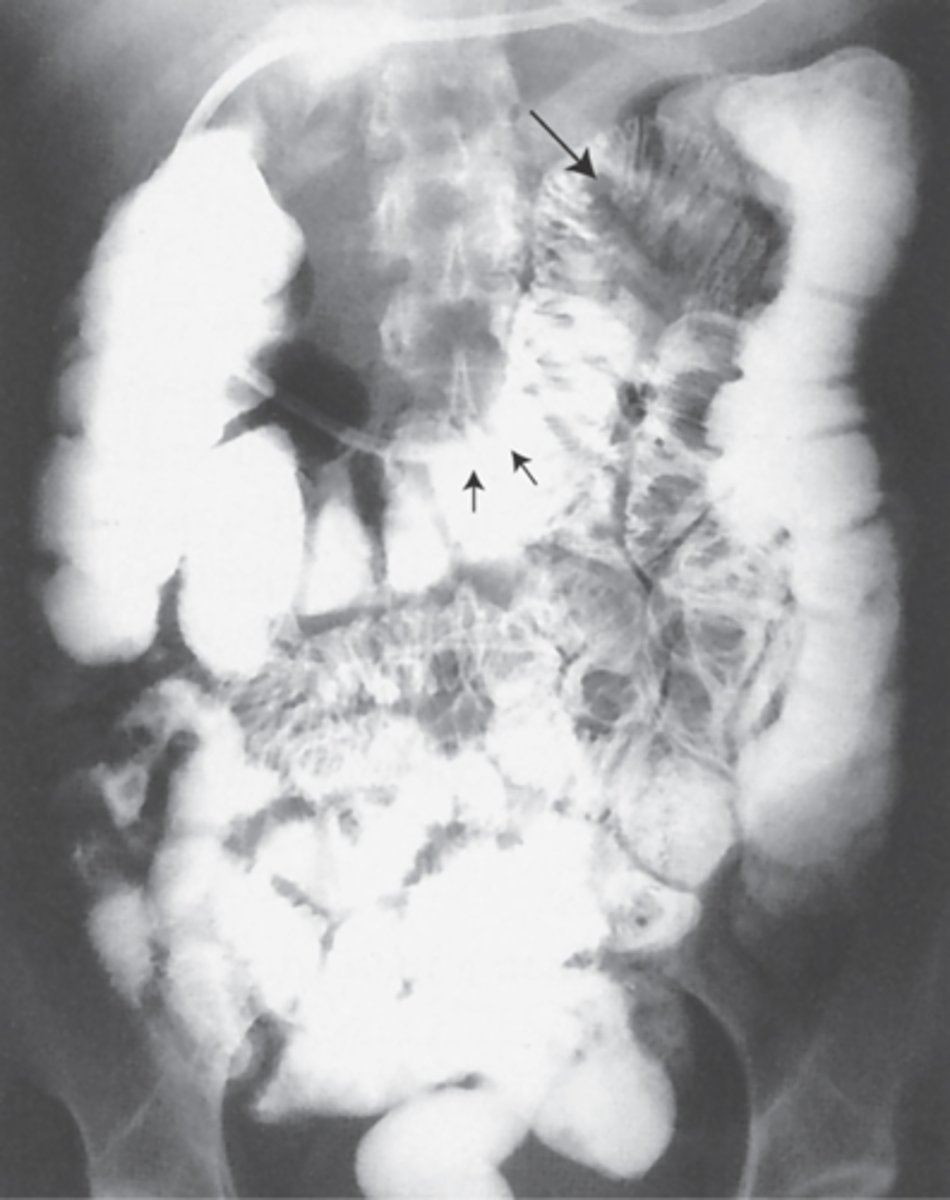 <p>Double contrast exam. Catheter inserted and advanced to duodenaljejunal flexure. Uses thin barium and air or methylcellulose.</p><p>Clinical indications: ileus, Crohn's, malabsorption syndrome, intestinal strictures, tumors, polyps, unexplained GI bleeding.</p>