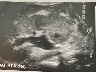 <p>A 30 year old woman arrives from the ED for a renal sonogram. She presents w/fever, nausea, and a sudden sharp pain on the rt side and back. This is the 1st time she has ever experienced this type of pain and reports being otherwise healthy. The renal sonogram shows an echogenic calculus w/posterior acoustic shadowing in the prox rt ureter causing obstructive hydro. w/in the dilated, primarily anechoic collecting system are low-level echoes that show a layering effect. What is the most likely diagnosis?</p>