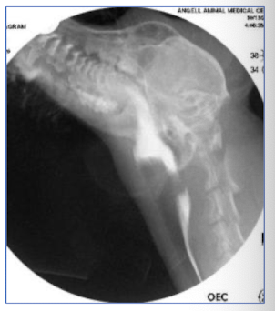 <p>congential disorder of upper esophageal (cricopharyngeal) sphincter</p>