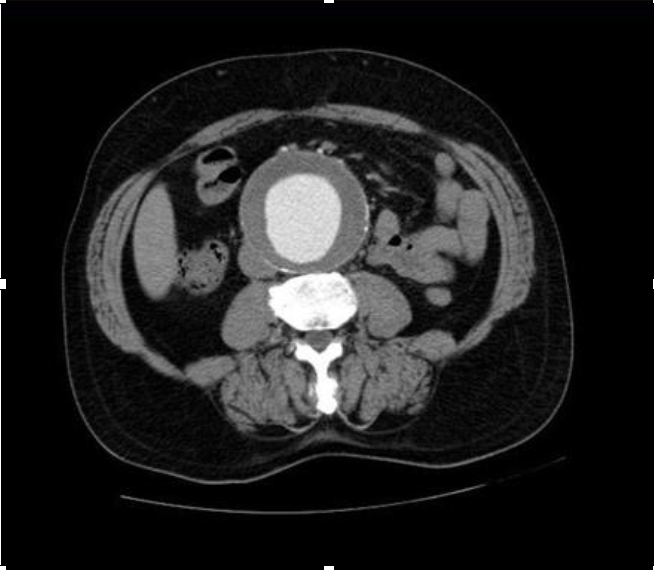 <p><em>CTA Abdomen/Pelvis IV contrast</em></p>