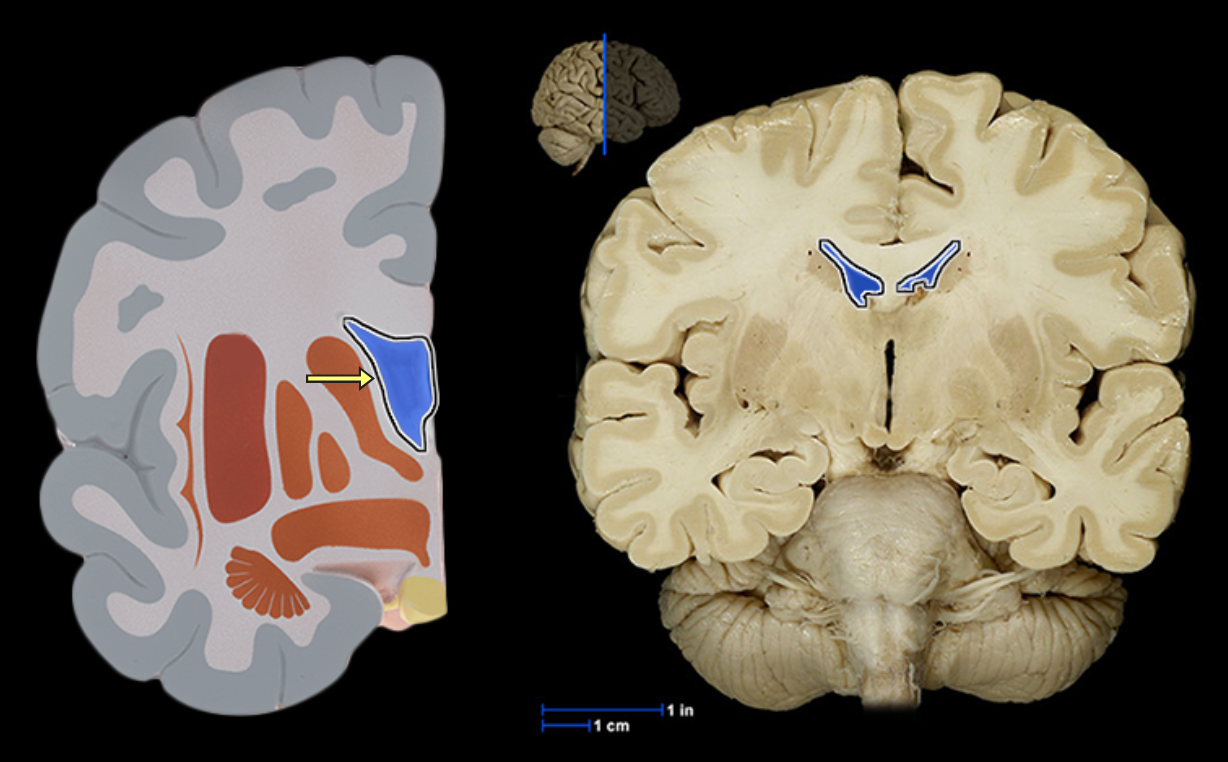 <p>Location:</p><ul><li><p>Deep within cerebral hemisphere</p></li></ul><p>Description:</p><ul><li><p>Paired cavity filled with cerebrospinal fluid (CSF)</p></li><li><p>Has anterior, posterior, and inferior extensions (horns)</p></li><li><p>Has choroid plexus that produces CSF</p></li><li><p>Connected to third ventricle via interventricular foramen</p></li></ul><p>Comment:</p><ul><li><p>Cerebral ventricular system includes: (1) paired lateral ventricles; (2) interventricular foramina (Monro); (3) unpaired third ventricle; (4) cerebral aqueduct (Sylvius); and (5) unpaired fourth ventricle</p></li></ul><p></p>