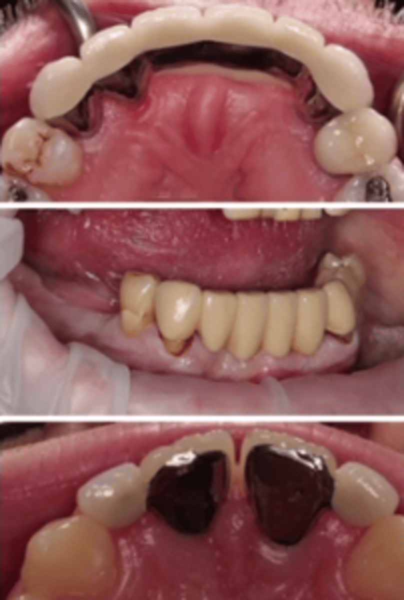 <p>Conventional (U) RBB (L)</p><p>- Short edentulous spans (1-2 missing teeth) </p><p>- Replacement of existing bridge</p><p>- Crowned or sound abutment tooth?</p>