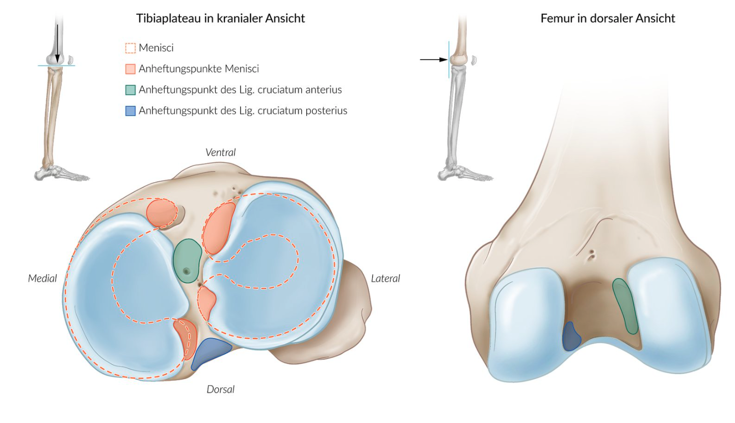 <p>A. Anterior cruciate ligament (ACL)</p>