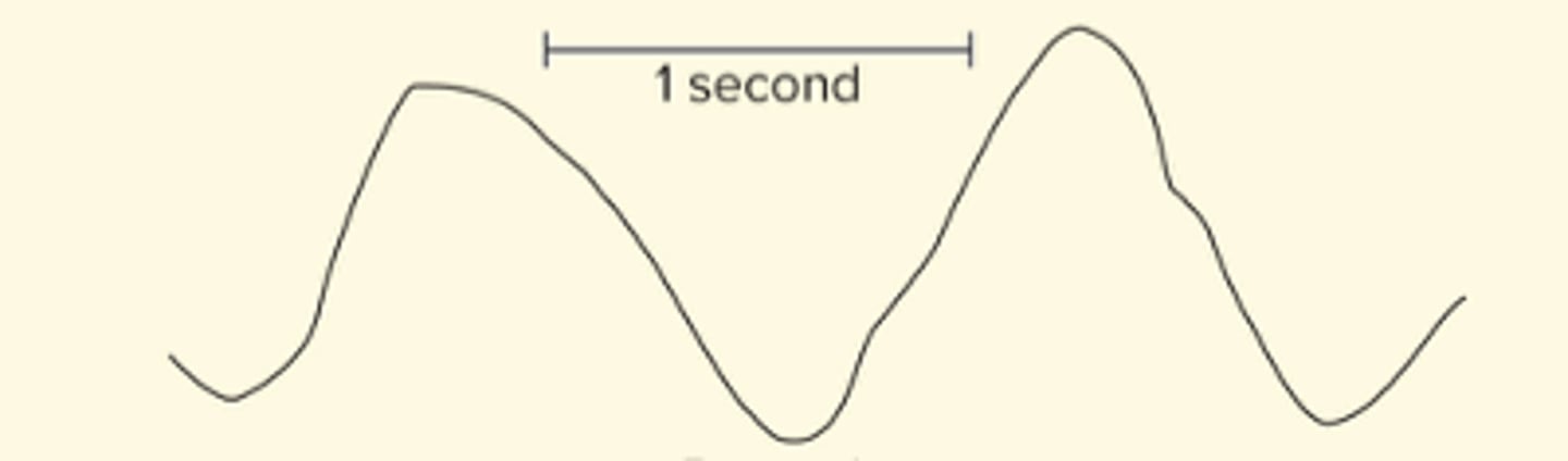 <p>- less than 3Hz</p><p>- High amplitude</p><p>- found in adults in deep sleep, adult with brain damage</p>